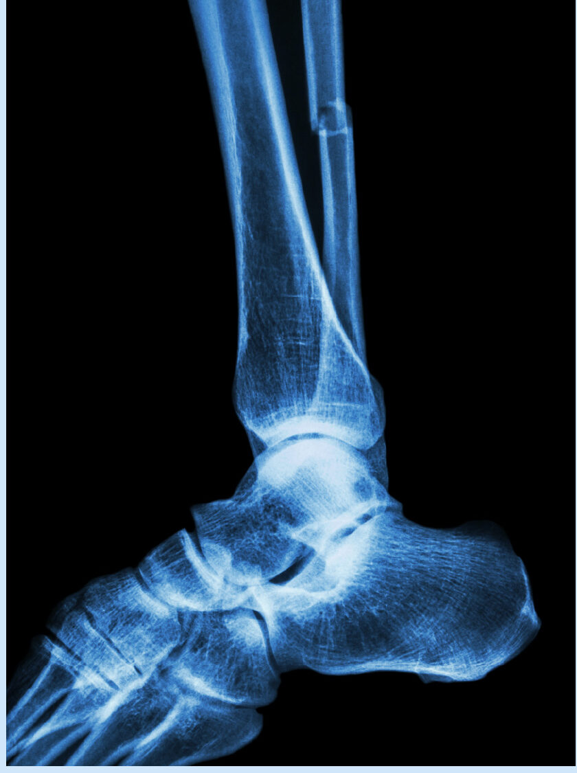 Ankle Injuries